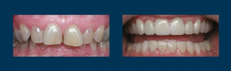 Before and after smile makeover