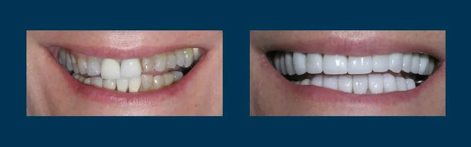 Before and after smile makeover