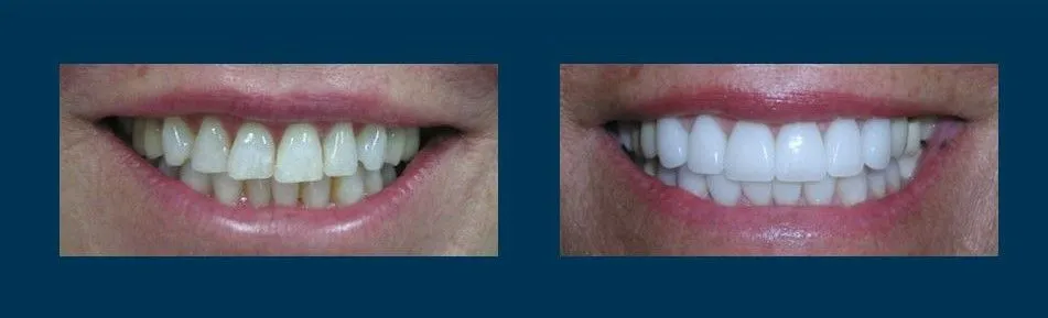 Before and after smile makeover