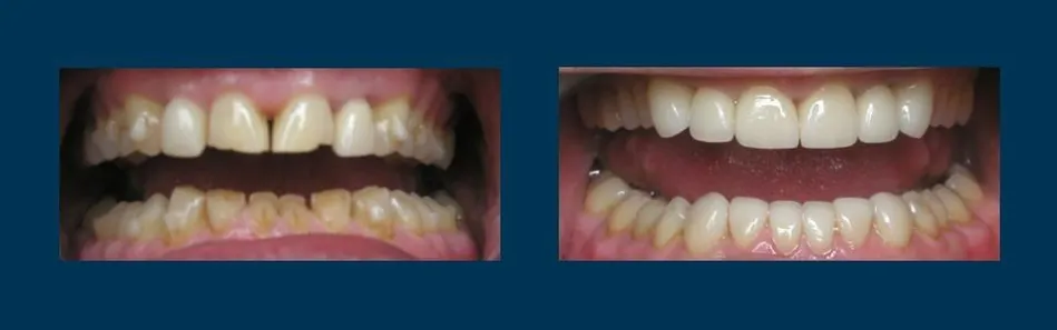 Before and after smile makeover