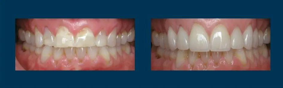 Before and after smile makeover
