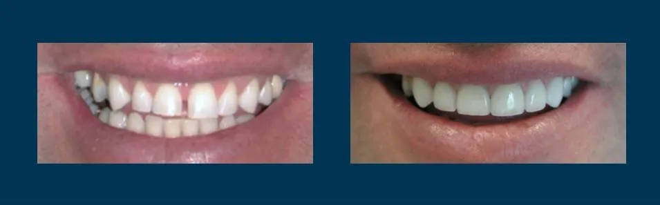 Before and after smile makeover