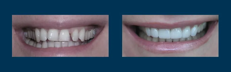 Before and after smile makeover