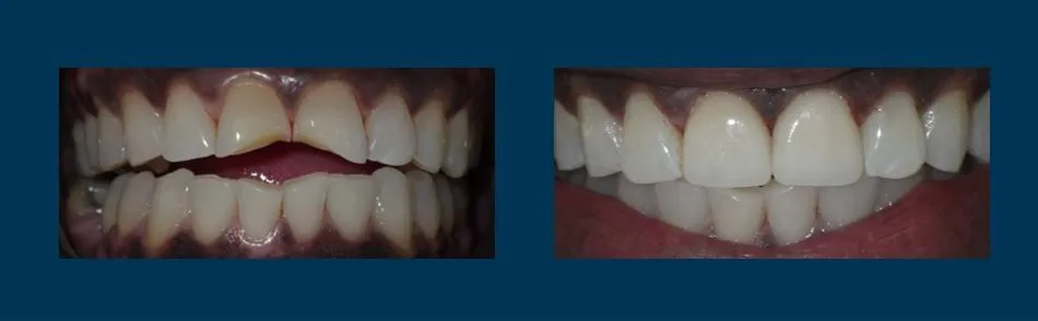 Before and after smile makeover